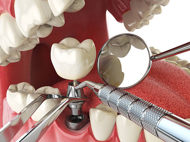 Best Emergency Denture Repair in Murrieta, CA